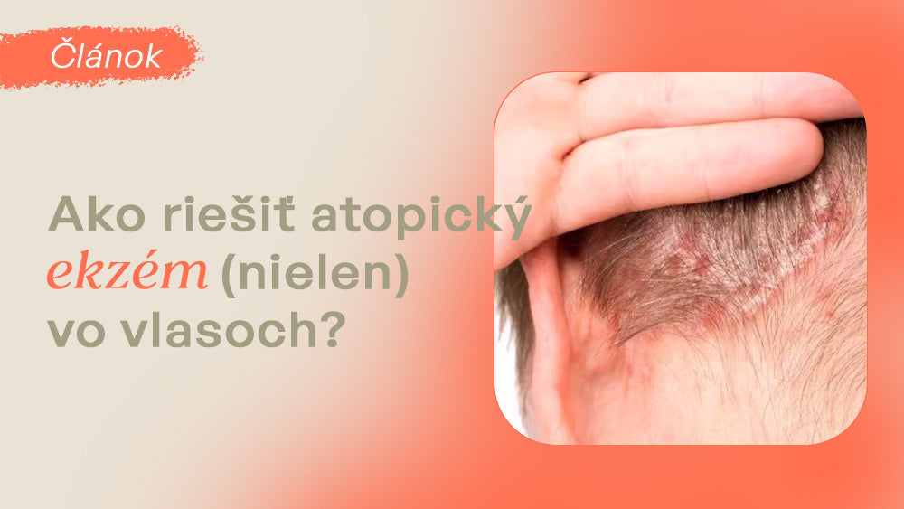Ako riešiť atopický ekzém (nielen) vo vlasoch