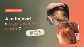 Stres a oslabená imunita spôsobili vypadávanie