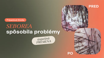 Rozsiahla seboroická dermatitída spôsobila nekonfort vlasovej pokožky a nadmerné vypadávanie.