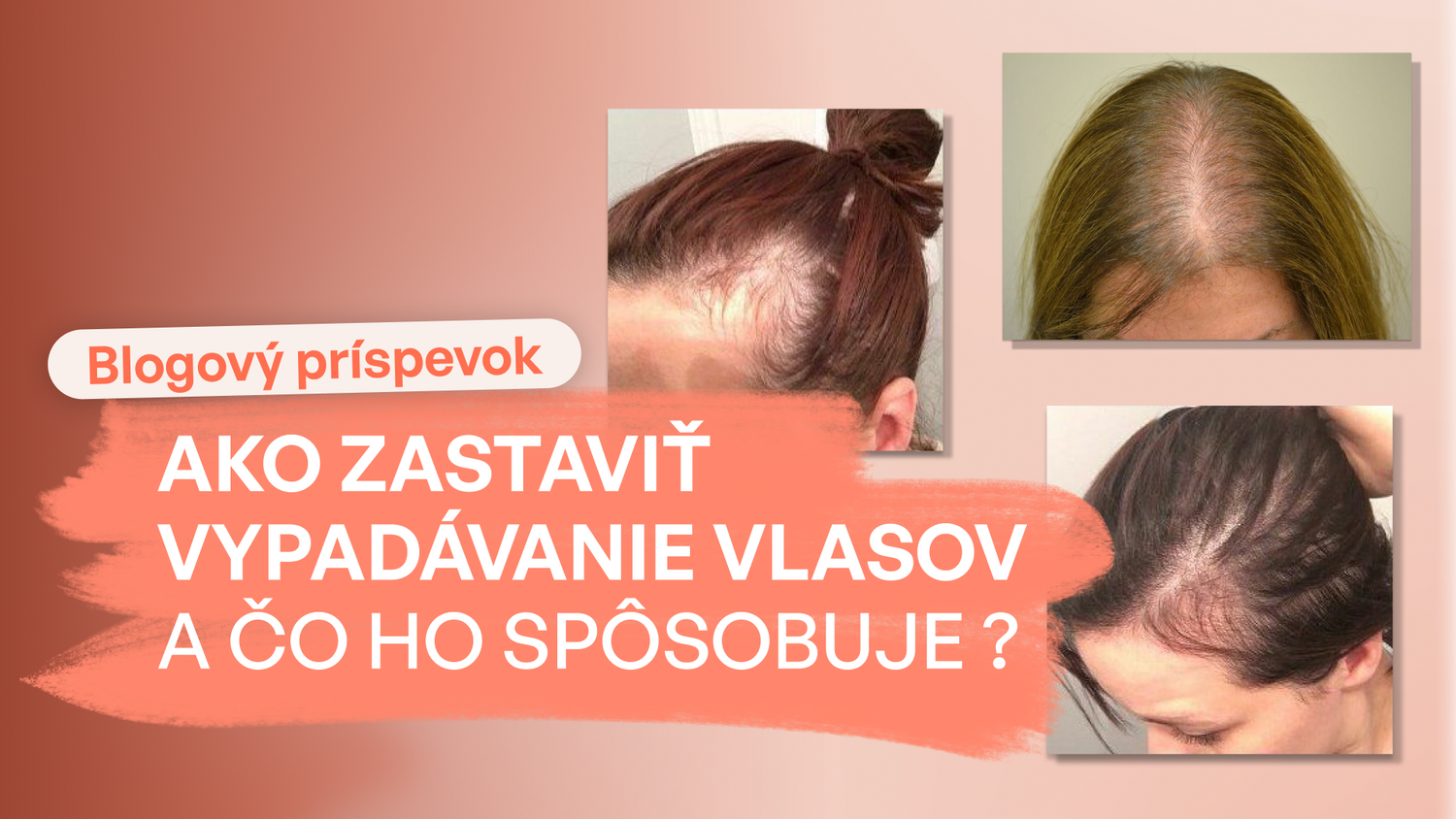 Ako zastaviť vypadávanie vlasov a čo ho spôsobuje ?